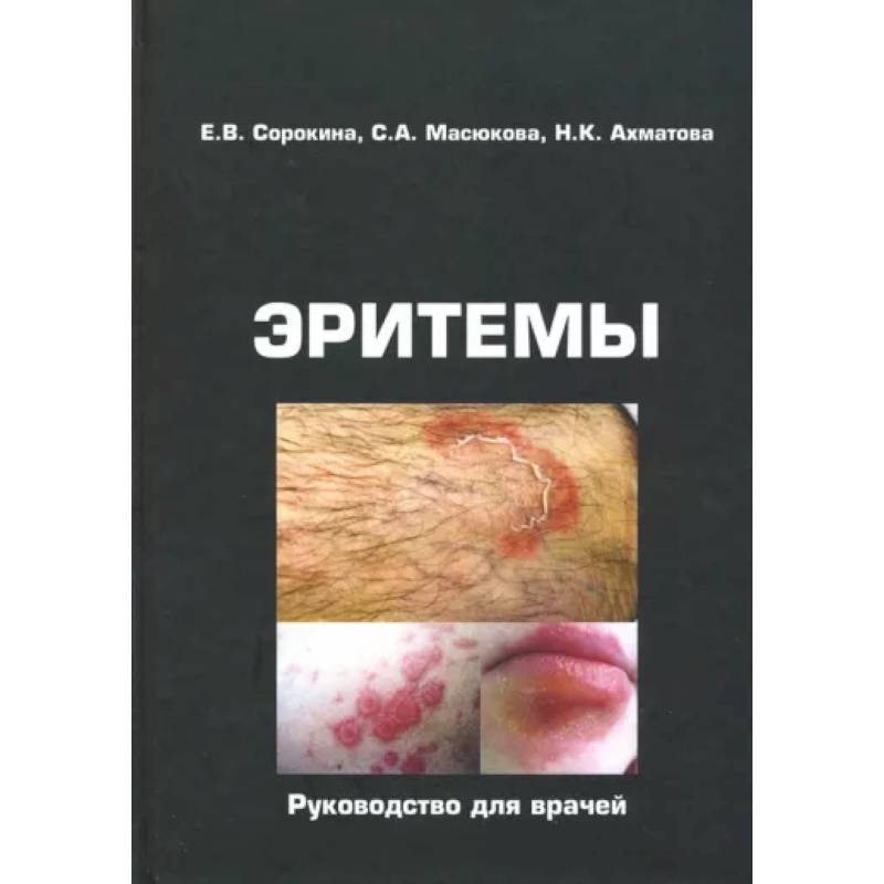 Эритемы. Руководство для врачей Эритемы. Руководство для врачей