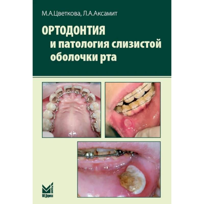 Ортодонтия и патология слизистой оболочки рта Ортодонтия и патология слизистой оболочки рта