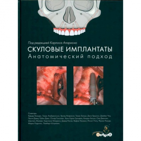 Специальная медицина, книга Скуловые имплантаты. Анатомический подход