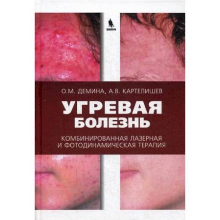 Медицинские энциклопедии и справочники, книга Угревая болезнь. Комбинированная лазерная и фотодинамическая терапия